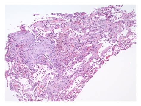 Transbronchial Biopsy Of The Lung Arrows Point At Myxoid Fibroblastic