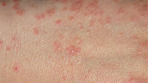 Everything You Need To Know About Scabies Scabies Scabies Rash