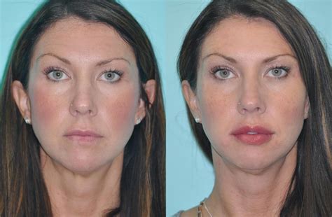 Lip Augmentation Photos Chevy Chase Md Patient 12393