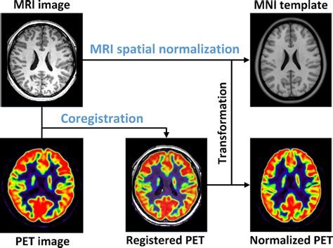 Flowchart Of Mri Aided Spatial Normalization The Mri Aided Spatial