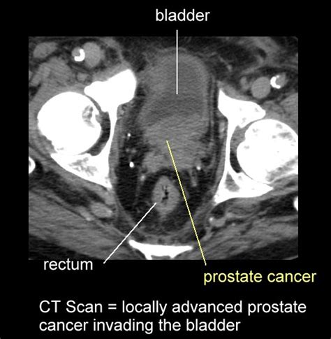 Prostate Imaging