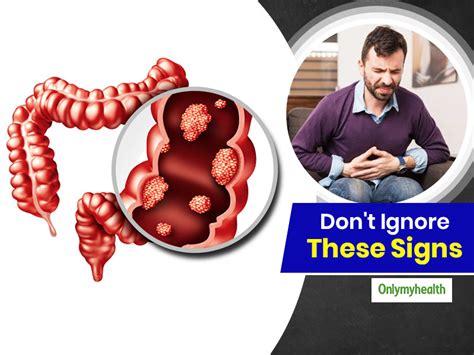 Dont Ignore The Signs Crucial Early Indicators Of Colon Cancer