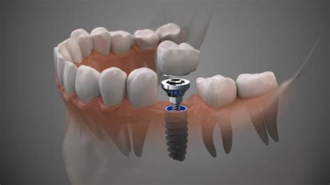 When Implant Restorations Can Be Minimally Invasive The Dental
