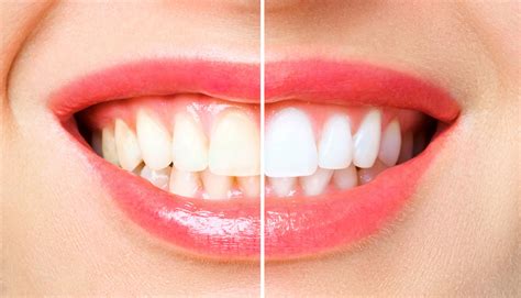 Wie lassen sich zähne am besten aufhellen? Zähne weißer machen beim Zahnarzt - VIP Bleaching
