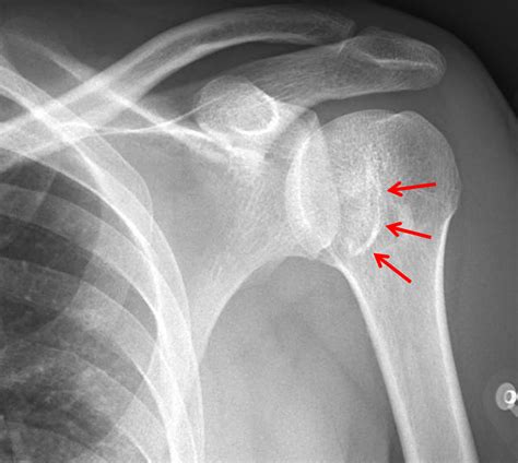 Shoulder Dislocation With Fracture