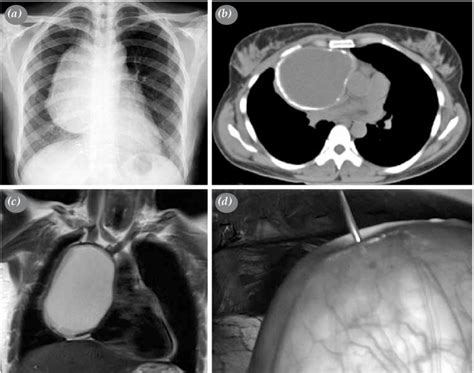 Anterior Mediastinal Hydatid Cyst In A 41 Year Old Female Patient A