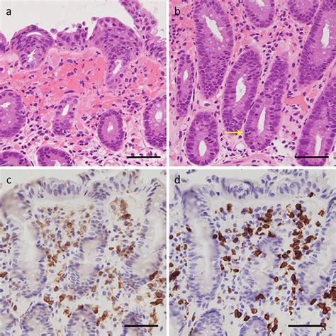 Figure4histopathological Findings In The Sigmoid Colon The