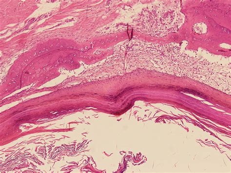 Pathology Outlines Epidermoid Inclusion Cyst