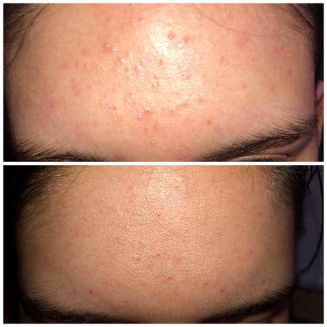 Banda Fungal Acne 4 Weeks Rskincareaddiction