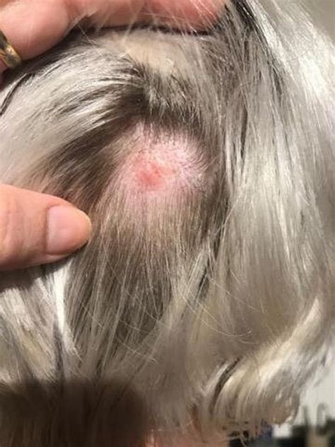 Guinea pigs, horses, and cats are highly susceptible but dogs are relatively resistant to the effects of the venom. Mum bitten by venomous false widow spider thought she'd ...