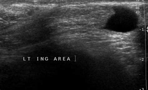 A hiatal hernia occurs when weakened muscle tissue allows your stomach to bulge up through your diaphragm. Indirect inguinal hernia | Image | Radiopaedia.org