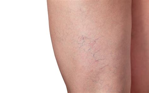 Varicose Veins And Capillary Veins In The Legs Stock Photo Download