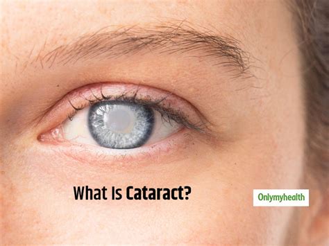 All About Cataract Causes Symptoms Treatment And More Onlymyhealth