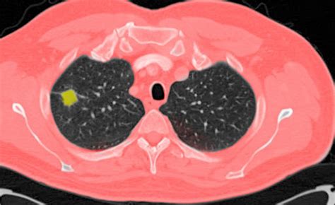 Benign Lung Nodules Identified Using Proteomic Biomarker Pulmonology Advisor