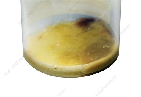 Infected Sputum Sample Stock Image C0178511 Science Photo Library
