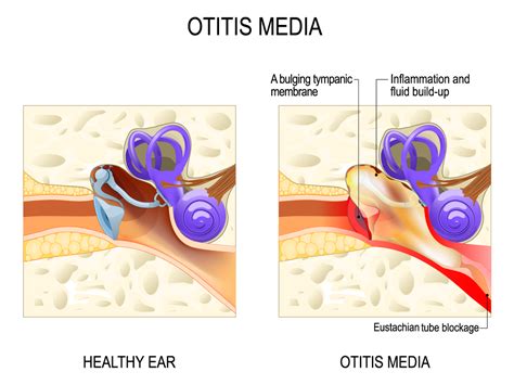 Middle Ear Fluid Developmental Effects On Children With Specific