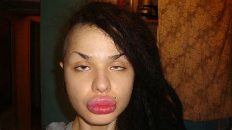 Kristina Rei Girl With The Worlds Largest Lips Pics