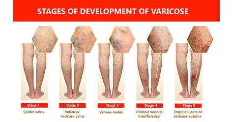 Svs When Do Varicose Veins Need Medical Attention