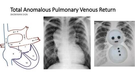Total anomalous pulmonary venous return 1, also known as scimitar syndrome, is related to sinoatrial node disease and heterotaxy. Pin by Chit Pyone Myet Chai on RADIO - CARDIAC SPOTTERS ...
