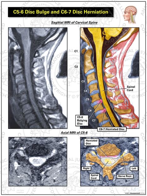 C5 6 Disc Bulge And C6 7 Disc Herniation
