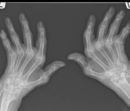 Rheumatoid Arthritis Radiology Case Radiopaedia Org
