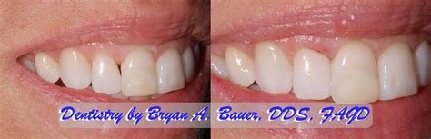 Black Triangle Teeth Treatment Options Bauer Smiles