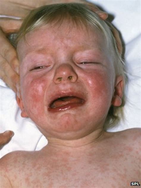 Qanda Measles And Mmr Bbc News