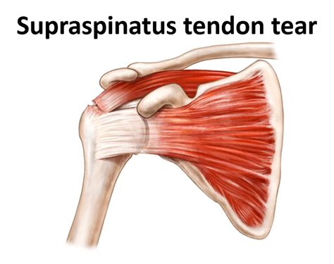Supraspinatus Tendon Tear Anatomy