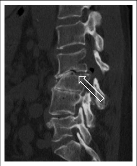 Sagittal Computed Tomography Ct Of The Lumbar Spine Demonstrating