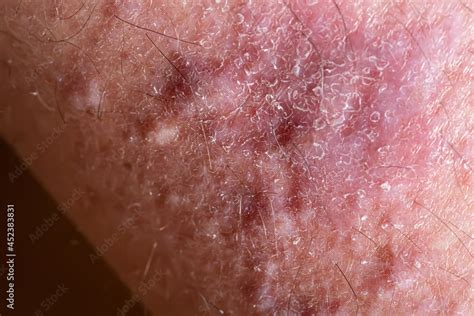 Lichen Planus On Leg Skin Close Up Dermatological Disease In Form Of