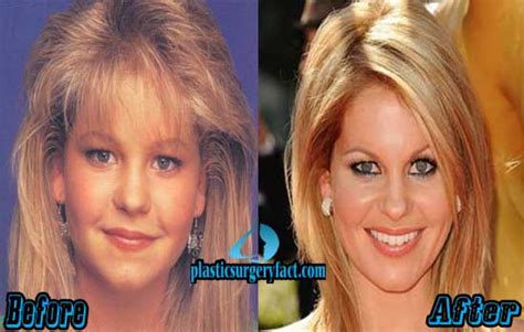 Candace Cameron Plastic Surgery Before And After Plastic Surgery Facts