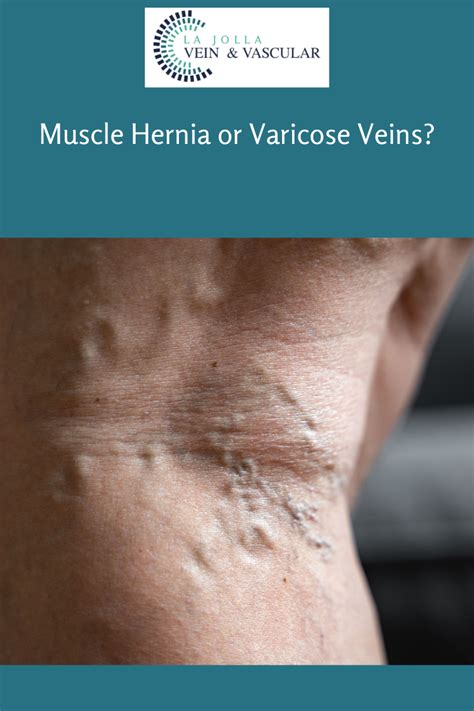 Hernia Or Varicose Veins