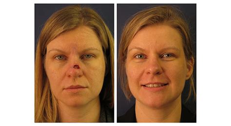 Facial Reconstruction Before And After Gallery Mount Sinai New York