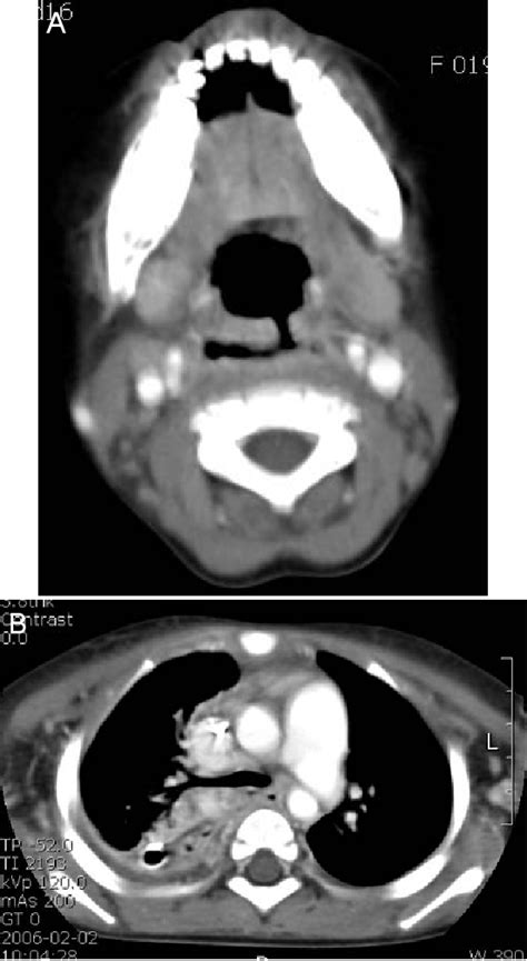 Figure 1 From Retropharyngeal Abscess And Acute Descending Necrotizing