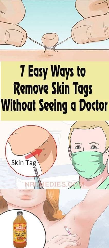 beauty 8 ways to naturally remove skin tags home remedies for skin skin tag removal skin tag
