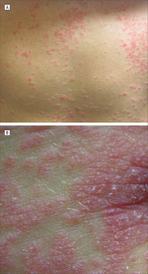 Acute Guttate Psoriasis In A 15 Year Old Girl With Epstein Barr Virus