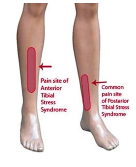 Recognition Treatment And Therapy For Painful Shin Splints Fit For Life