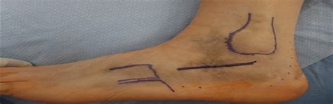 The Sinus Tarsi Approach For Calcaneal Fractures Techniques In Foot