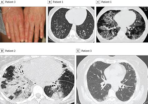 Hematopoietic stem cell transplantation this article is missing citations or needs footnotes.using inline citations helps guard against copyright hematopoietic stem cell transplantation remains a risky procedure with many possible complications; Anti-MDA5 Antibodies After Allogeneic Hematopoietic Stem ...