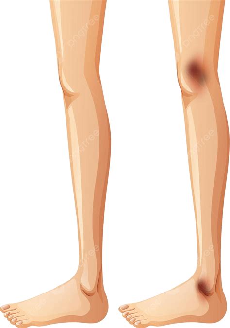 Human Legs And Bruise On White Background Ache People Background Vector