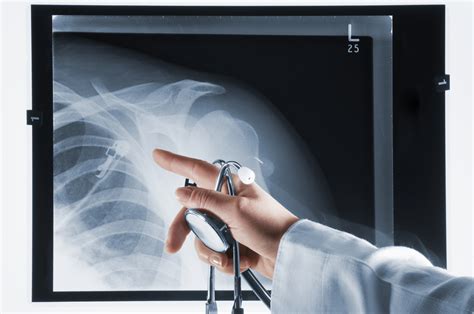 Doctor Pointing At X Ray Of Dislocated Shoulder With Stethoscope