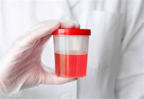 Urologista Particular em SP Dr Eduardo Costa causas de hemácias na urina que exigem