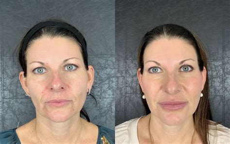 Lip Filler Before And After Bella Vi