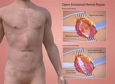 Incisional Hernia Repair Near Pasadena And Los Angeles CA