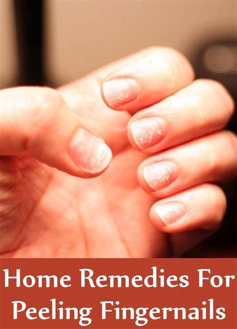 Top 5 Home Remedies For Peeling Fingernails Peeling Fingernails Nail