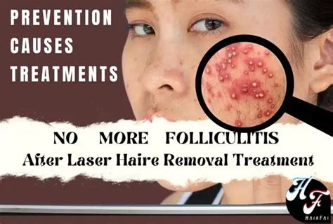 Folliculitis After Laser Hair Removal Treated And Explained Hair Fai