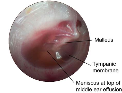 Understanding The Aetiology And Resolution Of Chronic Otitis Media From