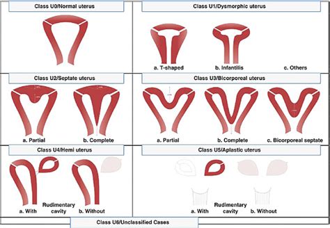 Eshre Classification Of Uterine Anomalies