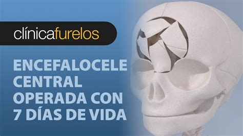 Encefalocele Hernia Cerebral Encefalocele Frontal Encefalocele Occipital