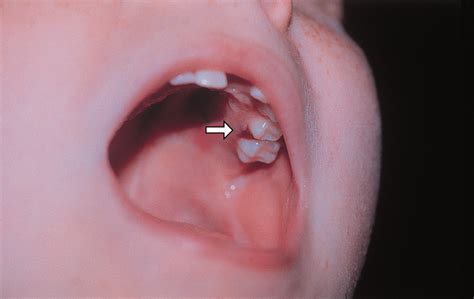 Scurvy Presenting As Painful Gait With Bruising In A Young Boy